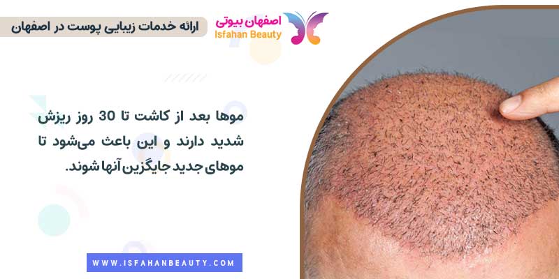 ریزش مو بعد از کاشت مو