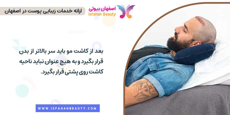نحوه خوابیدن بعد از کاشت مو