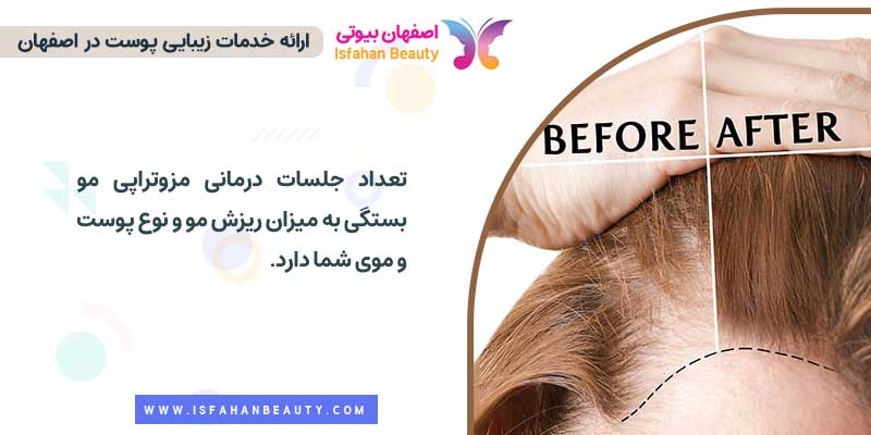 تعداد جلسات درمانی مزوتراپی مو