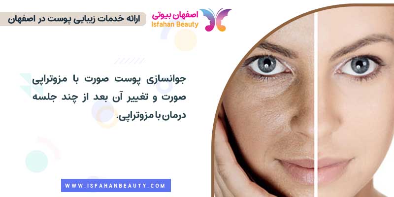عکس قبل و بعد مزوتراپی صورت| اصفهان بیوتی