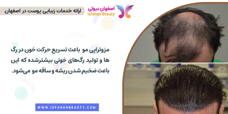 عکس قبل و بعد از مزوتراپی مو