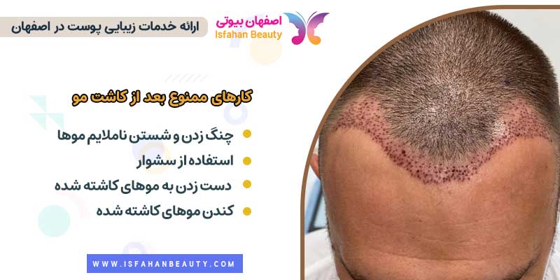 کارهای ممنوع بعد از کاشت مو