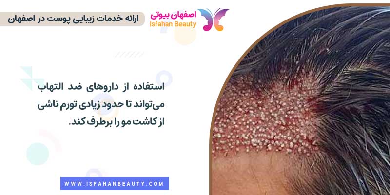 بهترین قرص بعد از کاشت مو