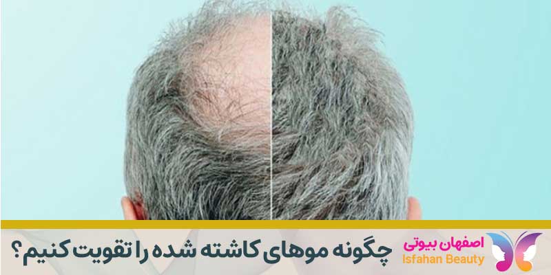 چگونه موهای کاشته شده را تقویت کنیم؟