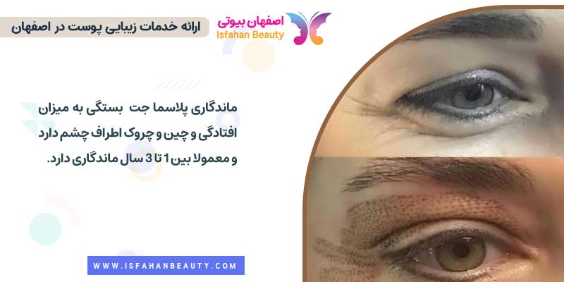 ماندگاری پلاسما جت پلک