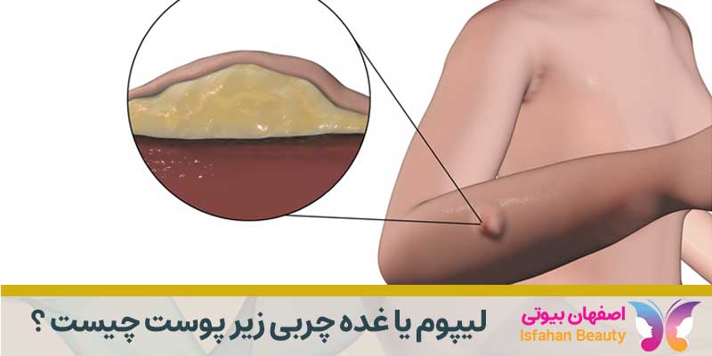 لیپوم یا غده چربی زیر پوست چیست