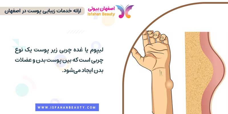 غده چربی زیرپوست یا لیپوم