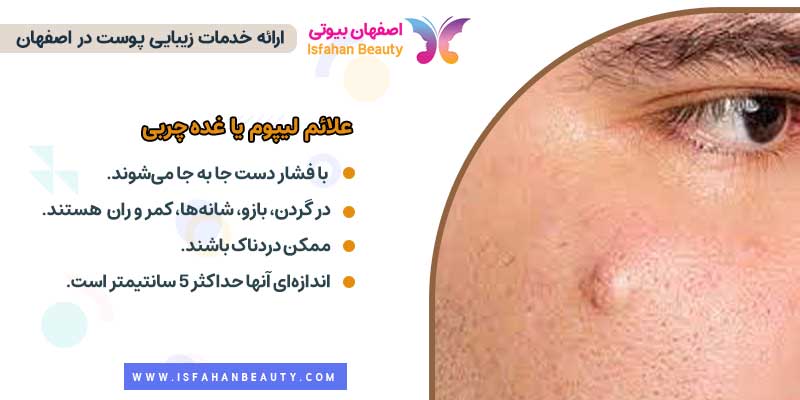 علائم لیپوم یا غده چربی