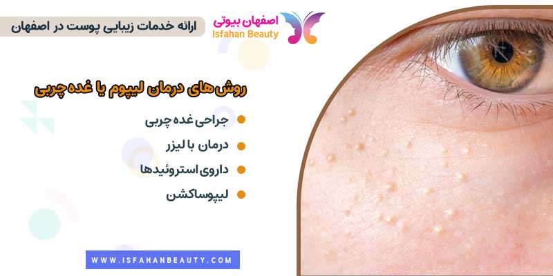 روشهای درمان غده چربی یا لیپوم