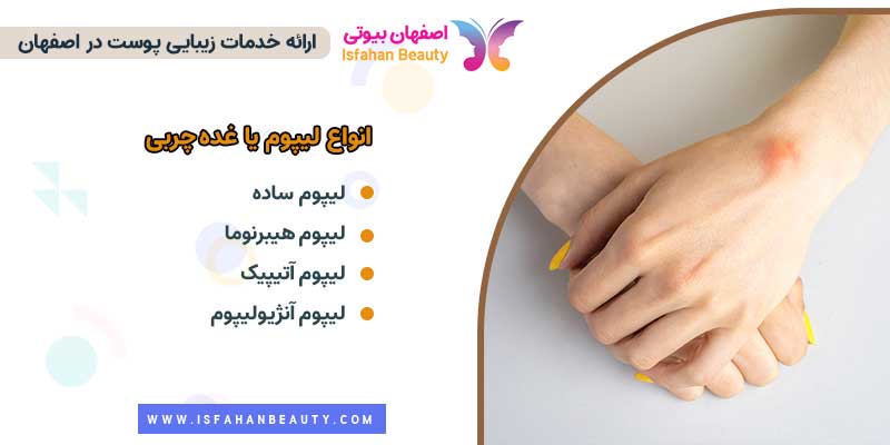 انواع لیپوم یا غده چربی