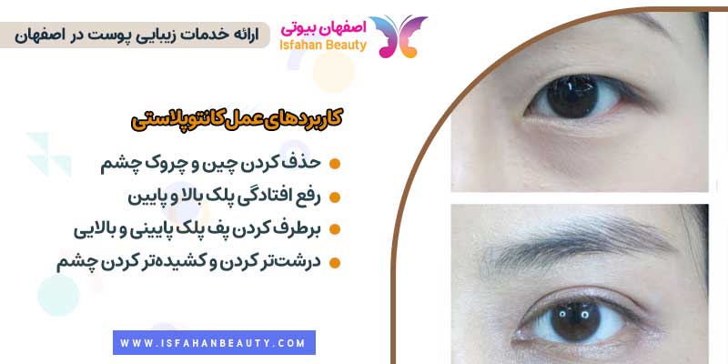 کاربردهای کانتوپلاستی