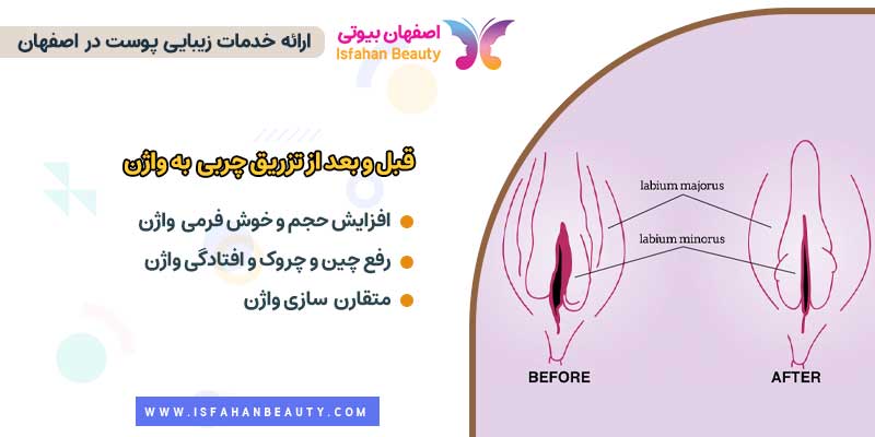 عکس قبل و بعد از تزریق چربی به واژن