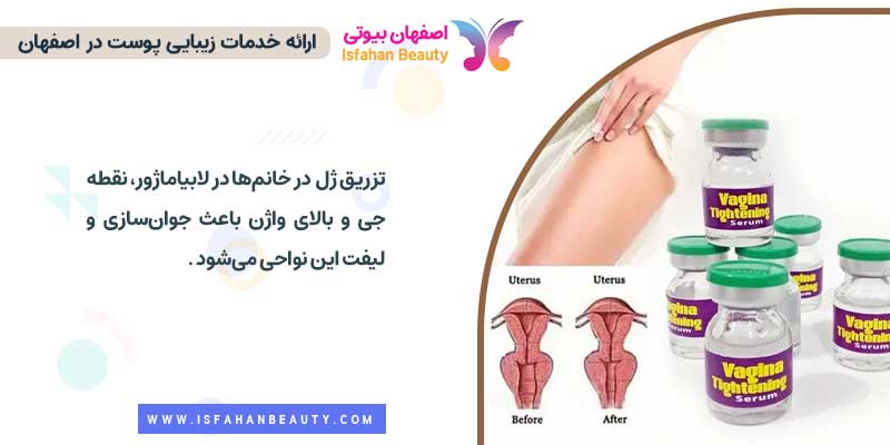 تزریق ژل به لابیا ماژور خانم ها 