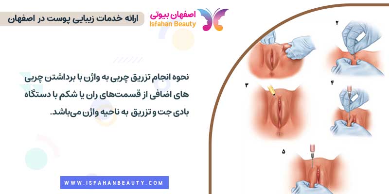 نحوه انجام تزریق چربی به واژن