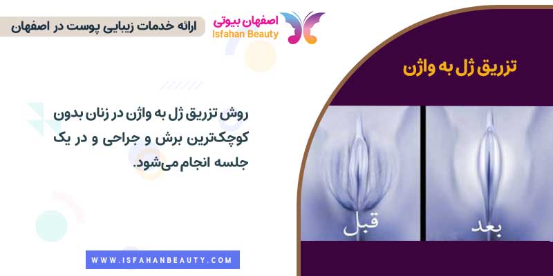 عکس قبل وبعد تزریق ژل به واژن