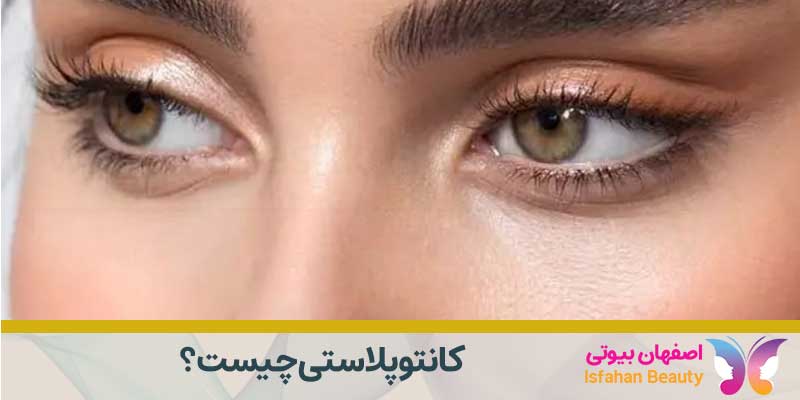 کانتوپلاستی چیست؟