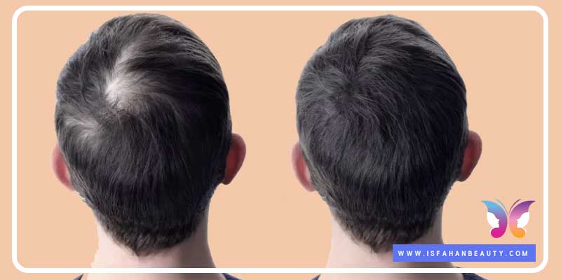 عکس قبل وبعد از مزوتراپی مو