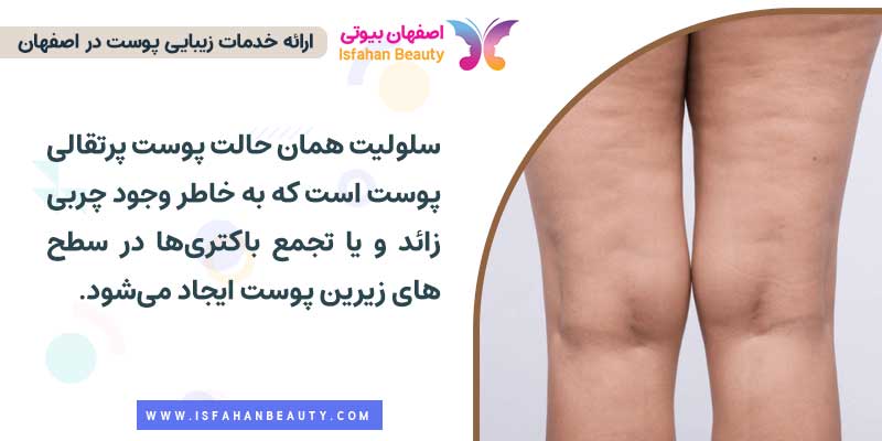 مزوتراپی سلولیت
