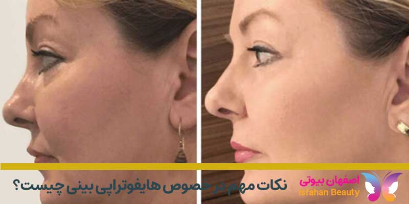 هایفوتراپی بینی در اصفهان
