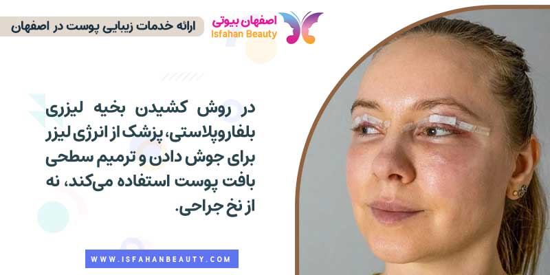 کشیدن بخیه لیزری بلفاروپلاستی