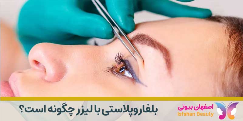 بلفاروپلاستی با لیزر
