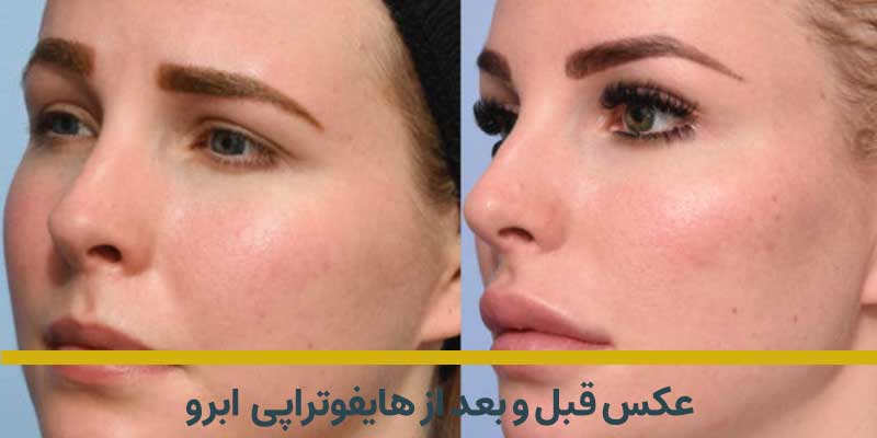 عکس قبل و بعد هایفو ابرو