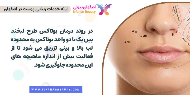 محل تزریق بوتاکس لبخند لثه ای
