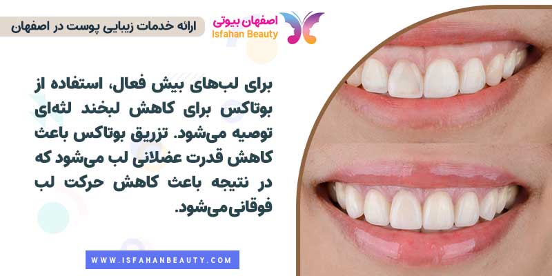 بوتاکس طرح لبخند