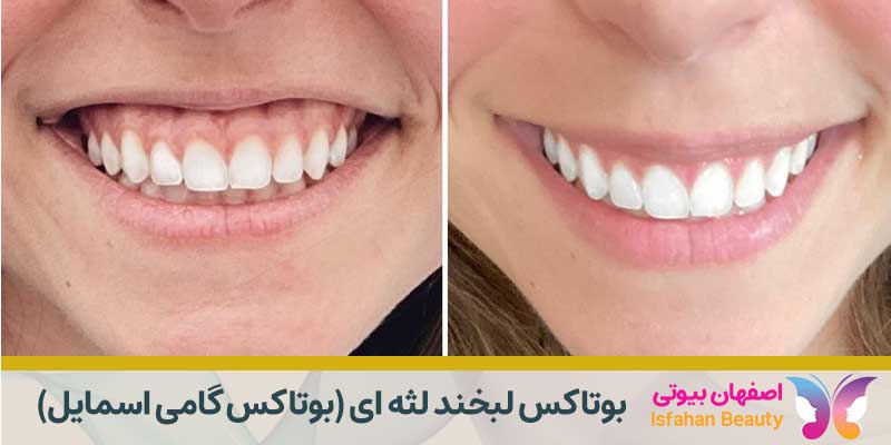 بوتاکس لبخند لثه ای | بوتاکس گامی اسمایل
