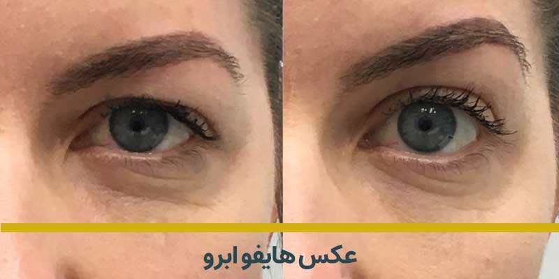 عکس هایفوتراپی ابرو قبل و بعد