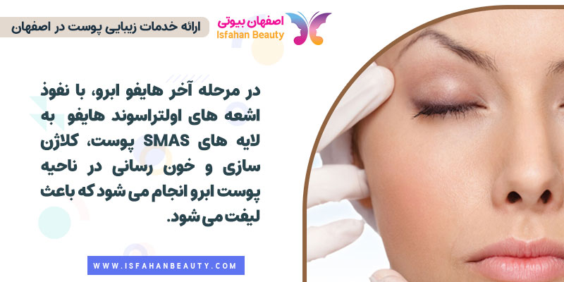 مراحل هایفو برای بالا کشیدن ابرو
