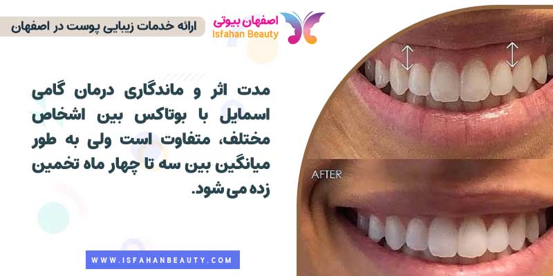 ماندگاری بوتاکس لبخند لثه ای