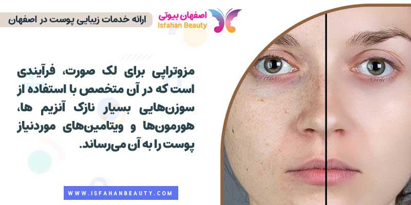 مزوتراپی لک صورت