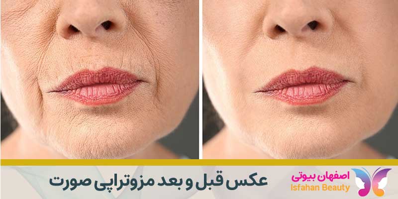 عکس قبل و بعد از مزوتراپی صورت