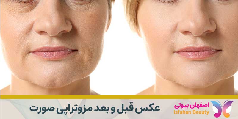 عکس قبل و بعد از مزوتراپی صورت