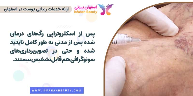 مزایای اسکلروتراپی