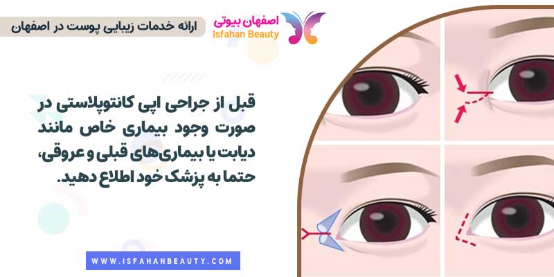 مراقبتهای قبل از جراحی اپی کانتوپلاستی