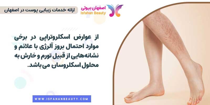 عوارض اسکلروتراپی