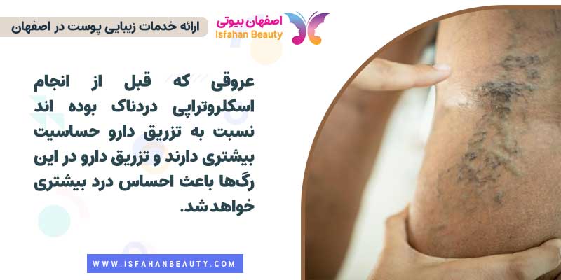 آیا اسکلروتراپی درد دارد؟