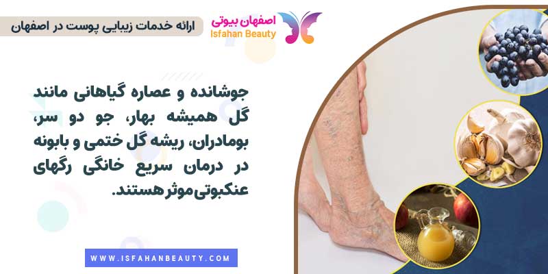 درمان سریع خانگی رگهای عنکبوتی