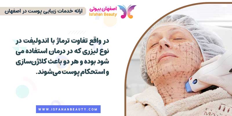 تفاوت ترماژ با اندولیفت