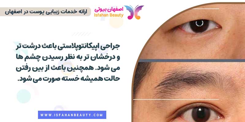 جراحی اپیکانتوپلاستی (Epicanthoplasty) چیست؟