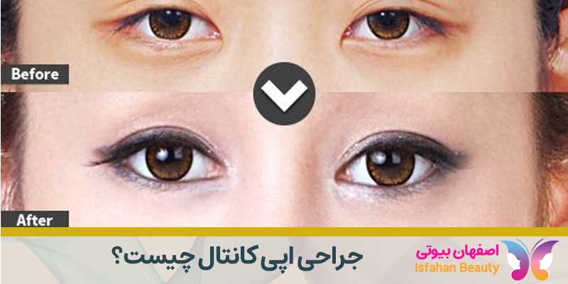 اپی کانتال چیست؟