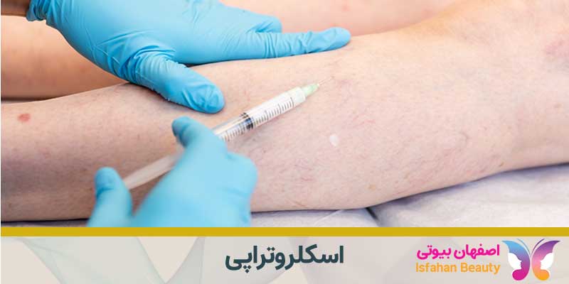 اسکلروتراپی