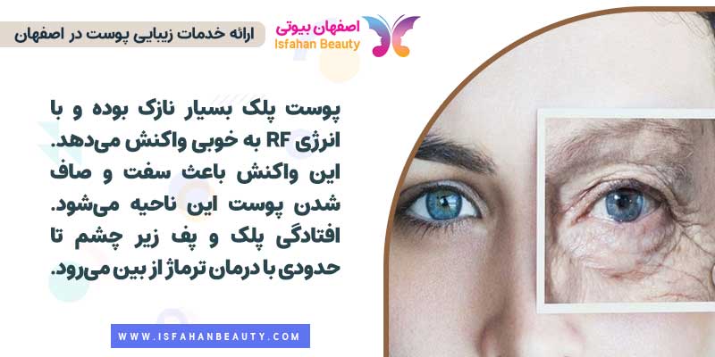 انواع ترماژ
