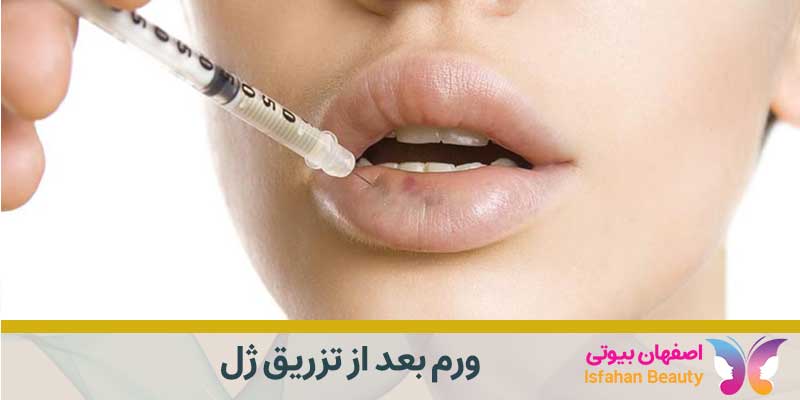 ورم بعد از تزریق ژل