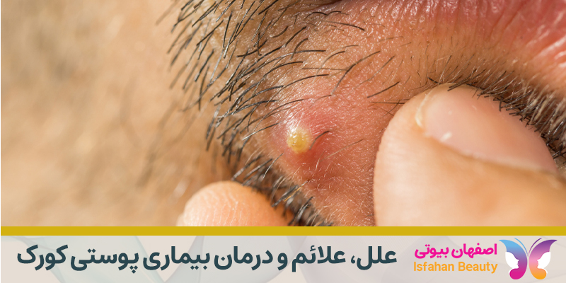 بیماری پوستی کورک، درمان کورک، علل کورک، علت کورک