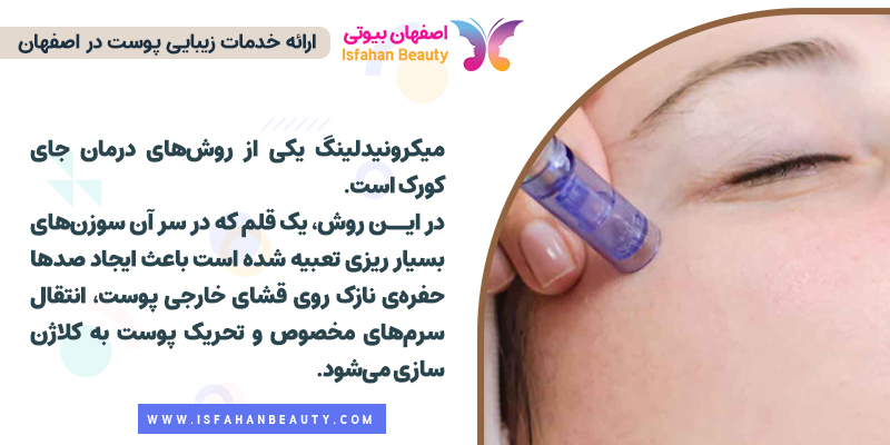 درمان جای جوش و کورک با میکرونیدلینگ