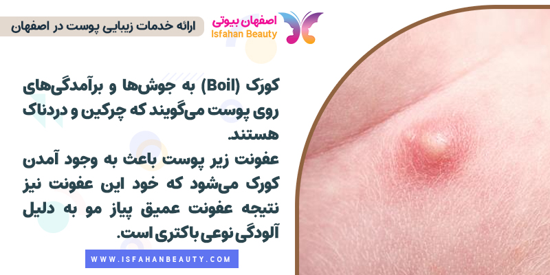 کورک چیست