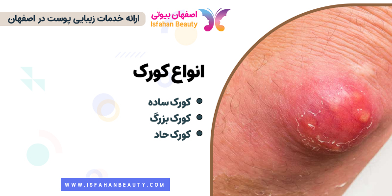 انواع کورک، کورک خطرناک